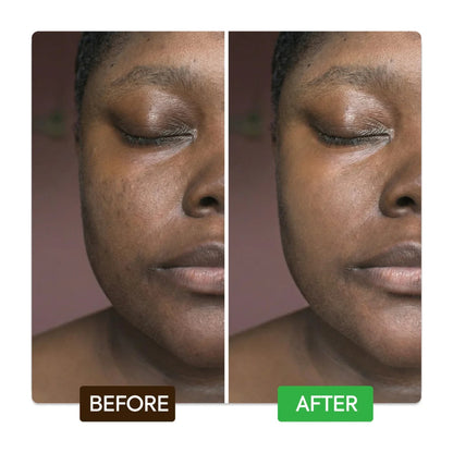 Fade stubborn dark spots with kojic azelaic acid kit